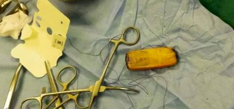 शख्स के पेट में छह महीने से था दर्द, डॉक्टरों ने ऑपरेशन किया तो निकला मोबाइल