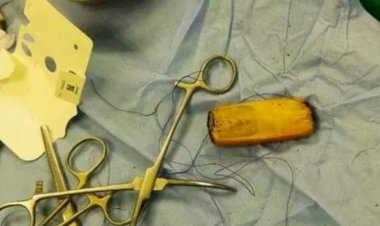 शख्स के पेट में छह महीने से था दर्द, डॉक्टरों ने ऑपरेशन किया तो निकला मोबाइल